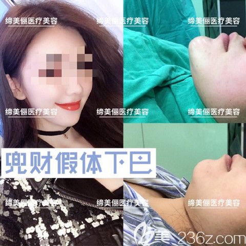 漯河締美儷楊勝發(fā)假體墊下巴案例