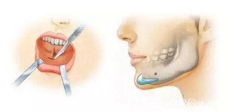 楊勝發(fā)醫(yī)生假體墊下巴手術(shù)過(guò)程