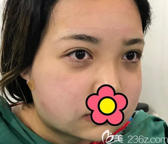 蘭州時光整形醫(yī)院面部吸脂前 蘭州時光整形醫(yī)院面部吸脂前