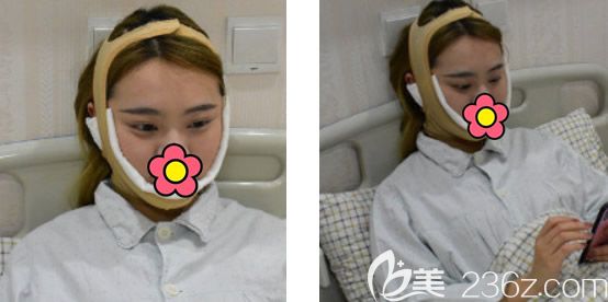 蘭州時光逯巖面部吸脂第2天效果 蘭州時光逯巖面部吸脂第2天效果