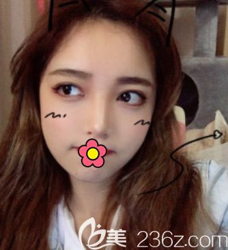 面部吸脂做完10天圖片 面部吸脂做完10天圖片