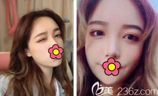 不磨骨如何改臉型?蘭州時(shí)光逯巖院長給我做完面部吸脂10天圖片和案例告訴你答案!