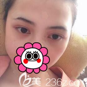 在衡陽割雙眼皮術(shù)后一周拆線