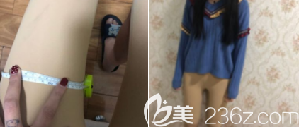 術(shù)后7天 術(shù)后7天