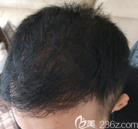 大家看看我花兩萬多找廣州碧蓮盛黃廣程做的頭頂加密2000單位效果咋樣