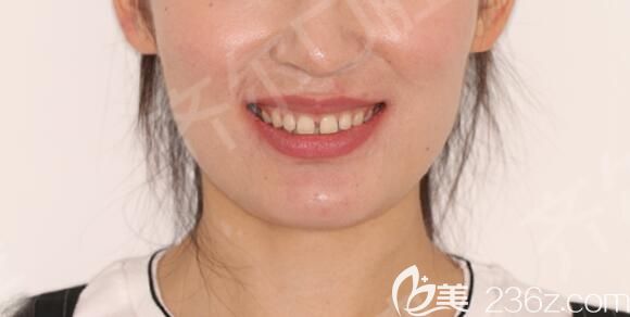 牙齒稀疏在杭州齊爾口腔做矯正前照片 牙齒稀疏在杭州齊爾口腔做矯正前照片