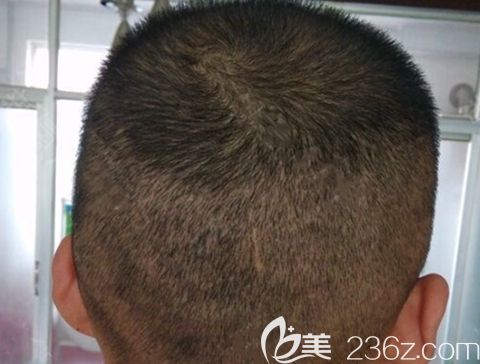 植發(fā)后取發(fā)區(qū)恢復(fù)圖片 植發(fā)后取發(fā)區(qū)恢復(fù)圖片