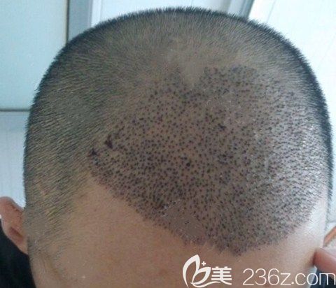 廣州碧蓮盛術(shù)后5天 廣州碧蓮盛術(shù)后5天