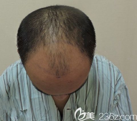 廣州碧蓮盛頭頂加密種植 廣州碧蓮盛頭頂加密種植