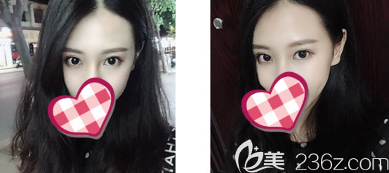 自從我在德州天宏做了全切雙眼皮之后我就成了他們家的鐵粉了