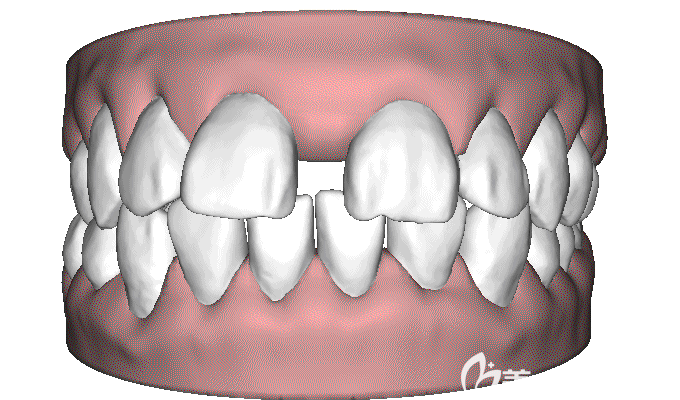 牙齒稀疏戴牙套有用嗎 牙齒稀疏戴牙套有用嗎