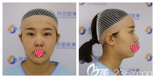 在唐山蘇亞美聯(lián)臣做肋軟骨隆鼻術(shù)前鼻子塌平 在唐山蘇亞美聯(lián)臣做肋軟骨隆鼻術(shù)前鼻子塌平