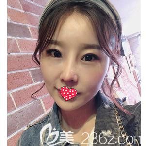 對自己的大鼻頭不滿已久 今天終于找李春雷醫(yī)生做肋軟骨鼻綜合術圓了我的翹鼻夢