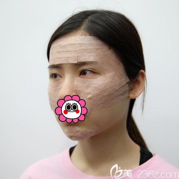 自體脂肪填充全臉術(shù)后即刻