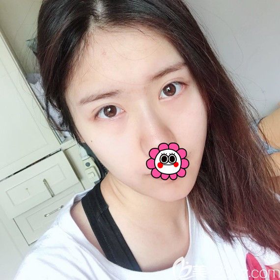 自體脂肪填充全臉術(shù)后五天