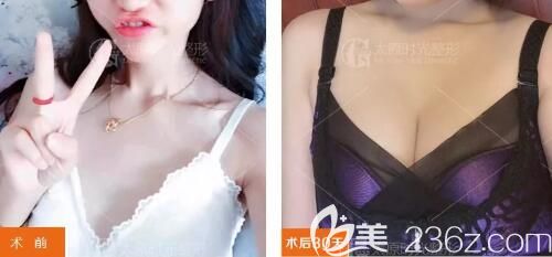 術(shù)前空杯絕望，術(shù)后望杯興嘆，兩者的差距只是因?yàn)樵谔瓡r(shí)光植入了300cc假體隆胸
