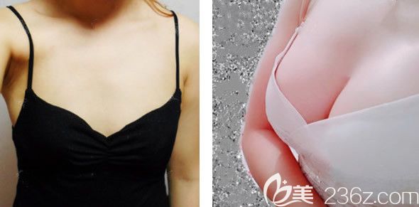 蘭州時光整形醫(yī)院假體隆胸效果