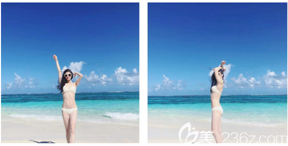 中信惠州醫(yī)院整形科陳虹醫(yī)生大腿吸脂案例 中信惠州醫(yī)院整形科陳虹醫(yī)生大腿吸脂案例