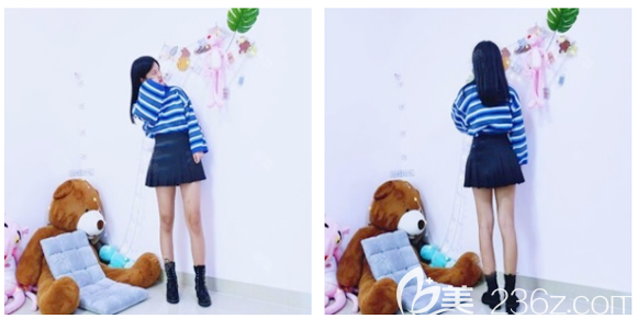 在中信惠州醫(yī)院做完大腿吸脂一個(gè)月就見效了 在中信惠州醫(yī)院做完大腿吸脂一個(gè)月就見效了