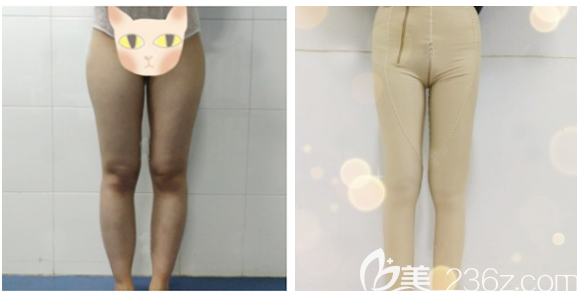 在中信惠州醫(yī)院整形科做吸脂術(shù)前照片 在中信惠州醫(yī)院整形科做吸脂術(shù)前照片