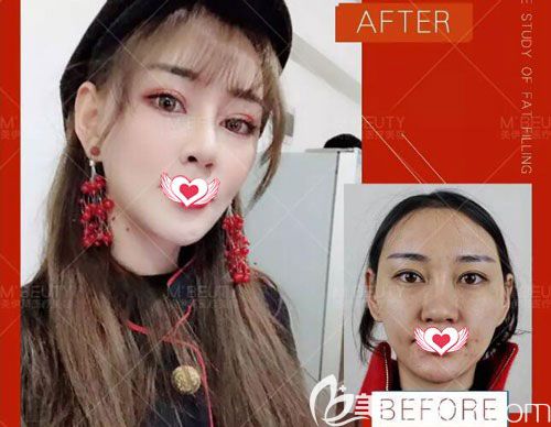 在昆明美伊萊整形找周誠(chéng)做肋軟骨隆鼻前后對(duì)比照