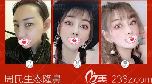 周誠(chéng)院長(zhǎng)做自體軟骨隆鼻一個(gè)月的恢復(fù)過(guò)程圖