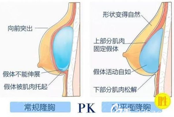 雙平面內窺鏡隆胸假體放置的位置
