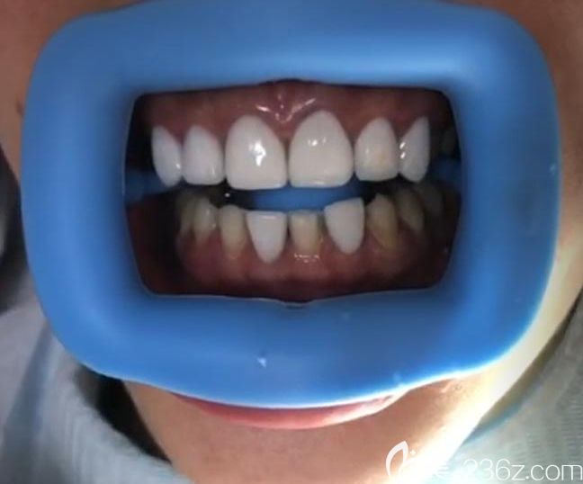 深圳質(zhì)美口腔牙齒貼面真人案例