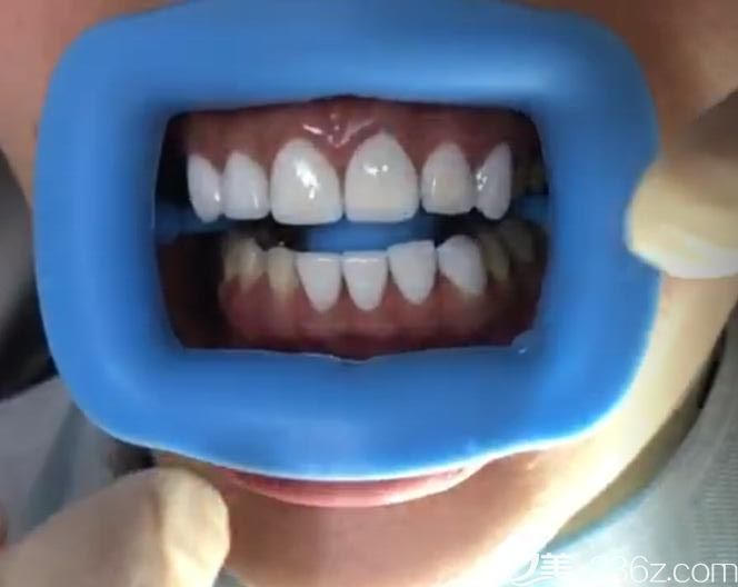 深圳質(zhì)美口腔做美白牙齒貼面案例