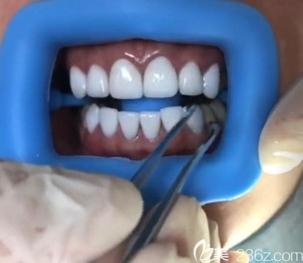  牙齒貼面案例 深圳質(zhì)美口腔