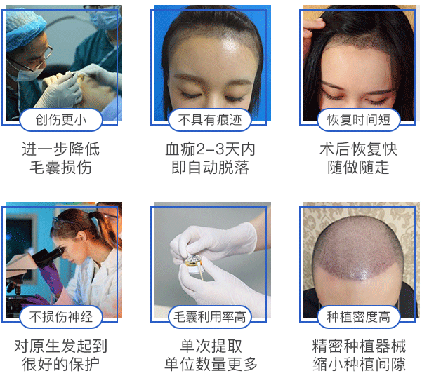 碧蓮盛SHT植發(fā)6大特點