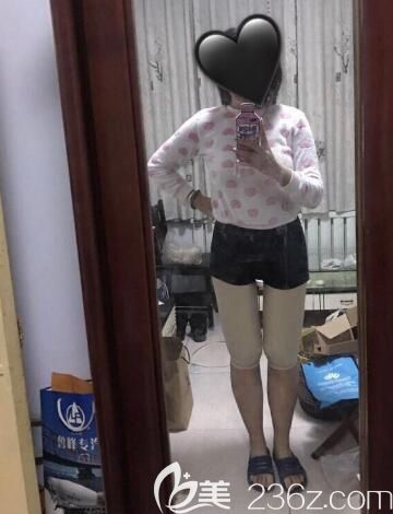 荊州華美大腿吸脂術(shù)后15天恢復(fù)圖