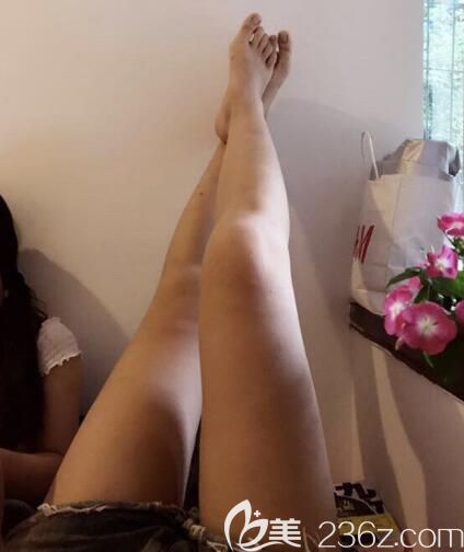 荊州吸脂哪家醫(yī)院好？荊州華美大腿吸脂<span style=