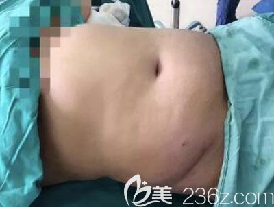 腰腹部脂肪堆積 腰腹部脂肪堆積