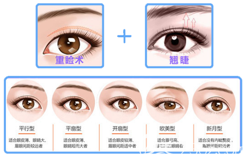 廣州海峽閆倫醫(yī)生雙眼皮手術(shù)特點(diǎn)