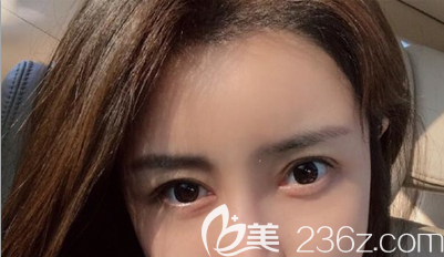 正規(guī)植發(fā)醫(yī)院我只認(rèn)深圳福田區(qū)碧蓮盛，賀俊給我做了發(fā)際線調(diào)整后我再也不用畫發(fā)際線了