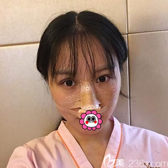 寧波藝星做鼻綜合術(shù)后即刻 寧波藝星做鼻綜合術(shù)后即刻