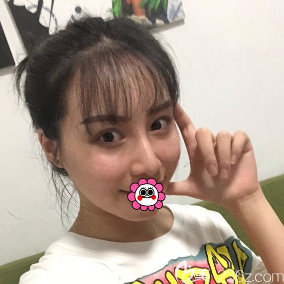 鼻綜合七天拆線后 鼻綜合七天拆線后