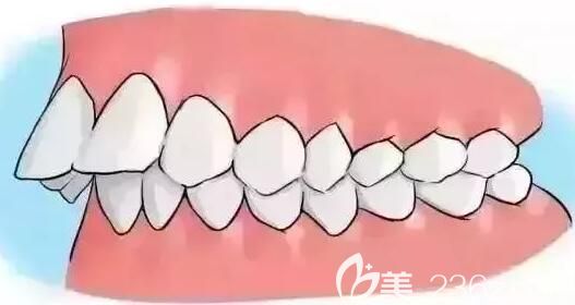 深圳格倫菲爾口腔員工做隱適美矯正齙牙 深圳格倫菲爾口腔員工做隱適美矯正齙牙