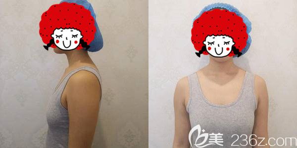 面診南京美貝爾術(shù)前胸部較小 面診南京美貝爾術(shù)前胸部較小