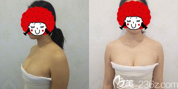 一周腋下拆線毛面曼托隆胸恢復(fù)中 一周腋下拆線毛面曼托隆胸恢復(fù)中