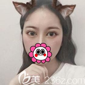 割雙眼皮術后4天效果圖