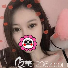 割雙眼皮術后10天效果圖