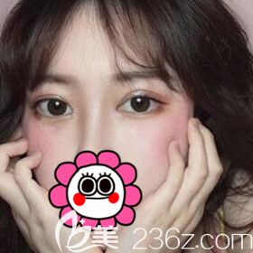 在長沙美之峰割雙眼皮術后15天效果圖