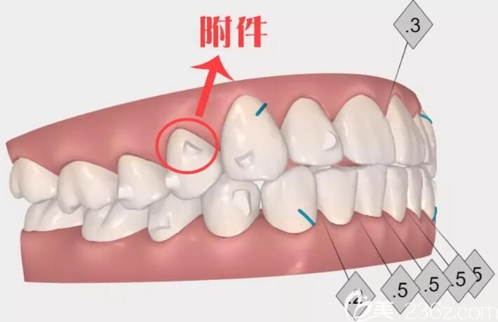 深圳格倫菲爾口腔隱適美矯正器附件 深圳格倫菲爾口腔隱適美矯正器附件