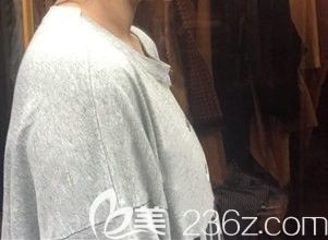 到微悅整形做自體脂肪前的自己 到微悅整形做自體脂肪前的自己