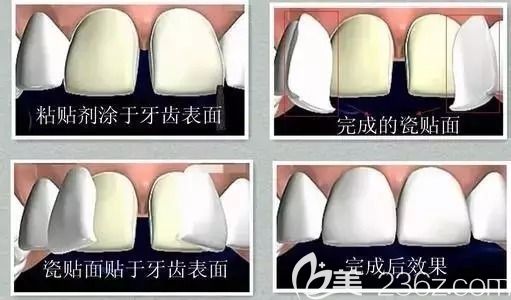 瓷貼面制作過程