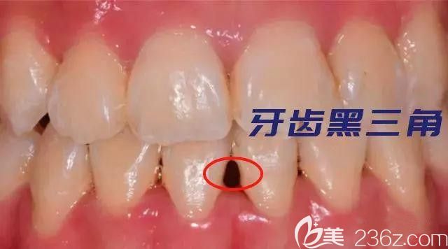 杭州齊爾口腔朱零教你預防牙套臉和黑三角