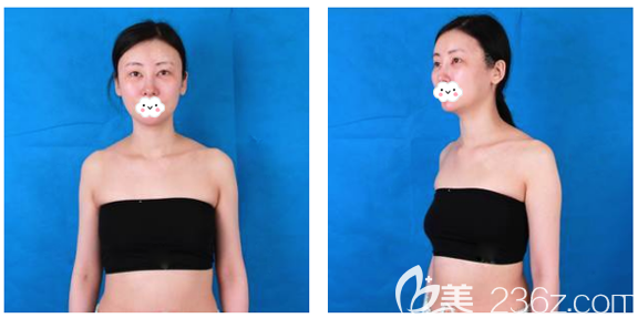 在廣州海峽做假體隆胸術前照片 在廣州海峽做假體隆胸術前照片