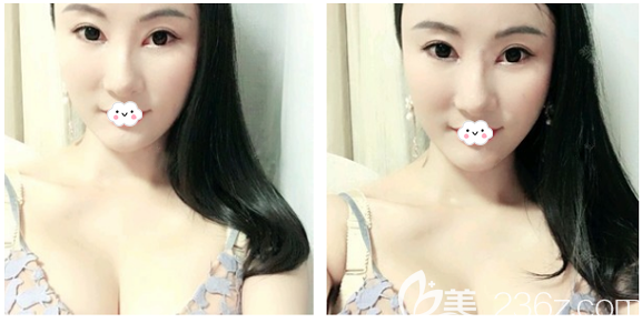 找廣州海峽閆愛躍做完假體隆胸后的真實感受 找廣州海峽閆愛躍做完假體隆胸后的真實感受